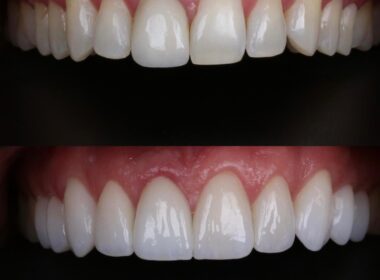 Dois sorrisos de antes e depois