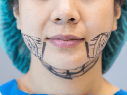 Rosto de uma mulheres com marcações para cirurgia de ortognática