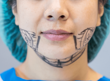 Rosto de uma mulheres com marcações para cirurgia de ortognática