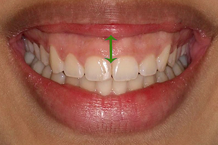 Sorriso de uma pessoa com Sorriso gengival