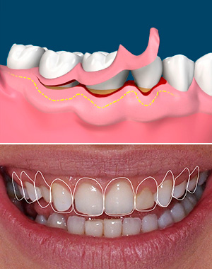 Imagem que retrata como funciona a cirurgia de gengivoplastia