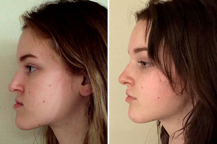 Foto de uma mulher de antes e depois de cirurgia ortognática
