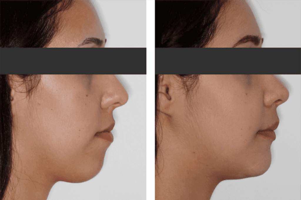 Foto de uma mulher de antes e depois de cirurgia ortognática