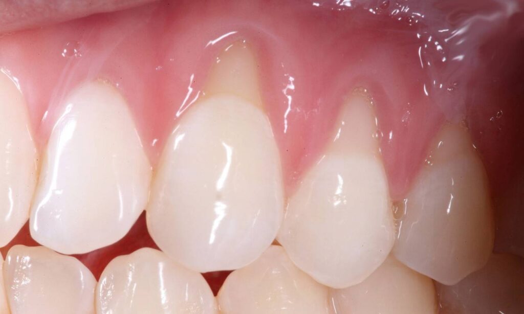 Sorriso de uma pessoa com Retração gengival