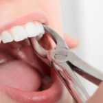 Boca aberta com alicate segurando um dente