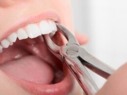 Boca aberta com alicate segurando um dente