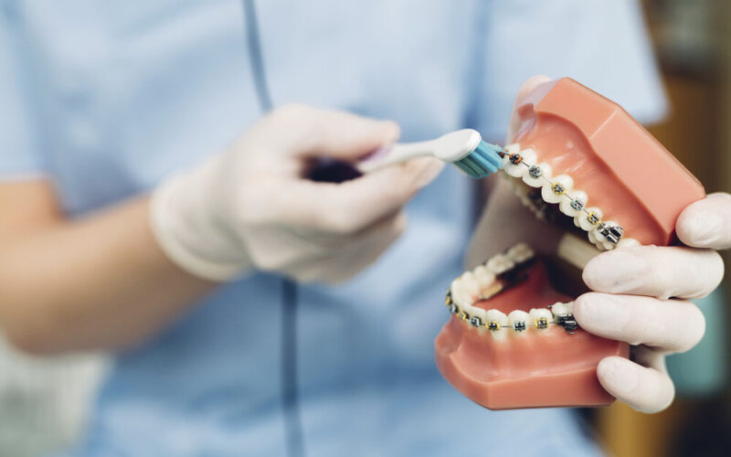 10 dicas de higienização para pacientes que usam aparelho odontológico