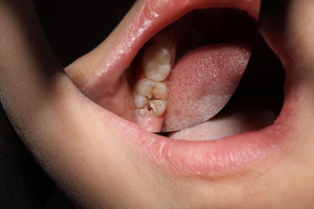 Mouth com dentes cariados e língua visível