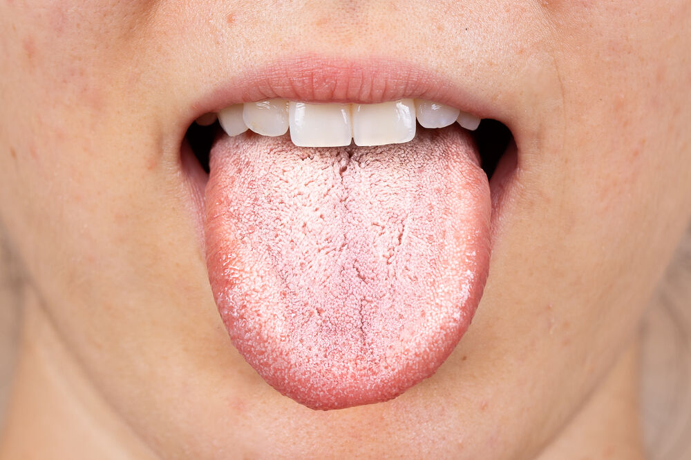 close-up-view-white-furry-tongue-young-caucasian-girl-common-symptom-candida-albicans-yeast-infection.jpg