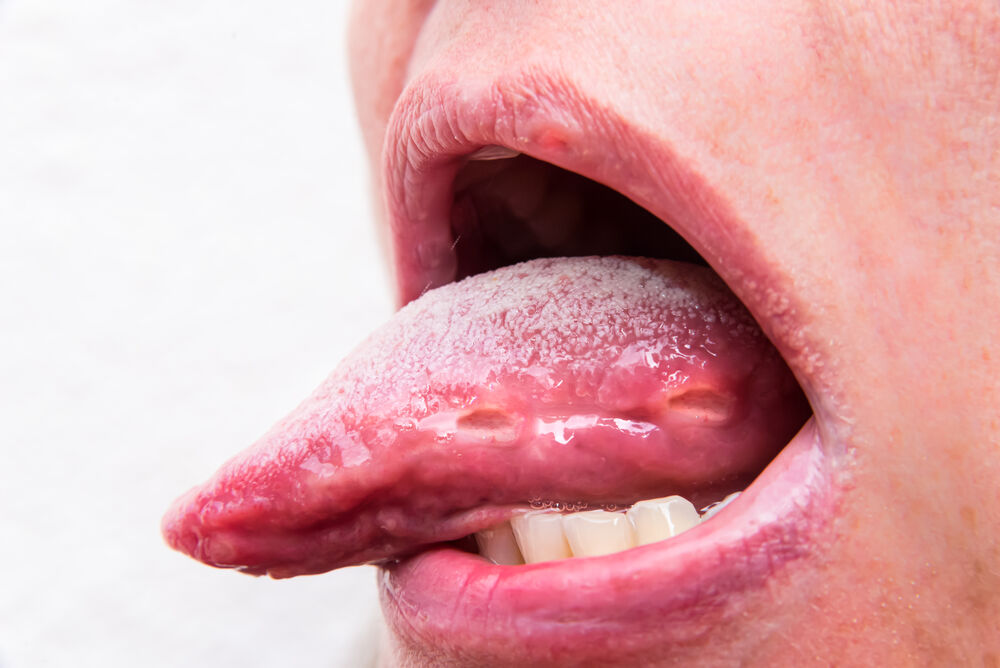 Close da língua com papilas linguais inflamadas, representando alterações associadas à papilite lingual transitória.